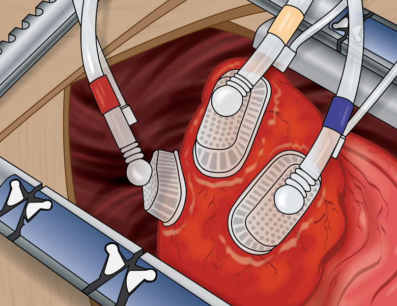 Tentacles Heart Positioner: Tips and Pitfalls for Optimal OM Exposure